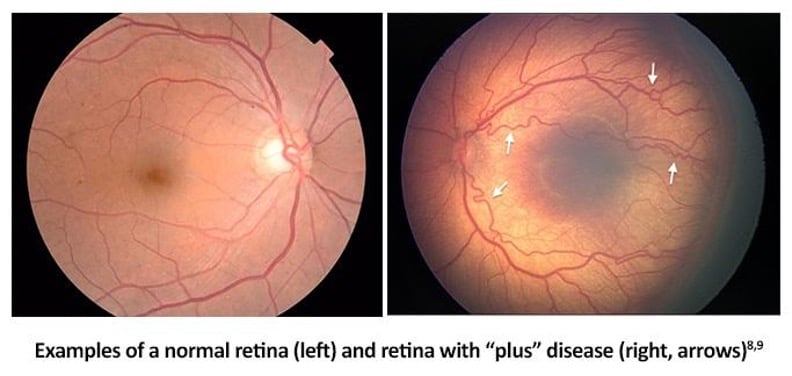 Healthy infant retina compared with a retina showing Plus disease, including vessel dilation and tortuosity.