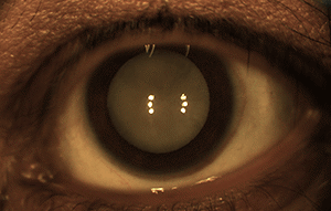 A cataract is a clouding of the lens in an eye which results in vision loss